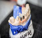 implant üstü protezler